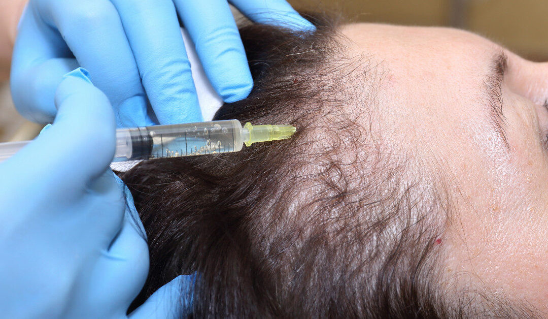 Discover Natural Results with PRP for Hair Loss