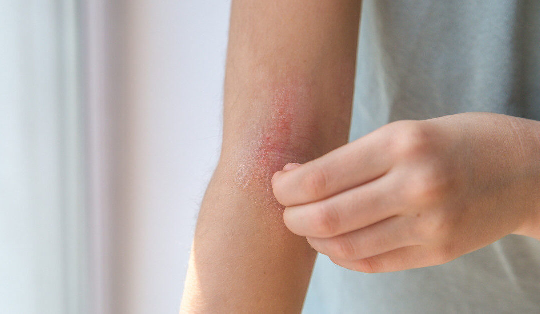 Eczema Relief Starts with the Right Care