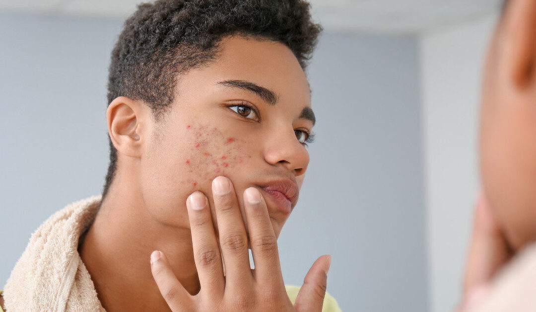 Managing Acne During the Back to School Season