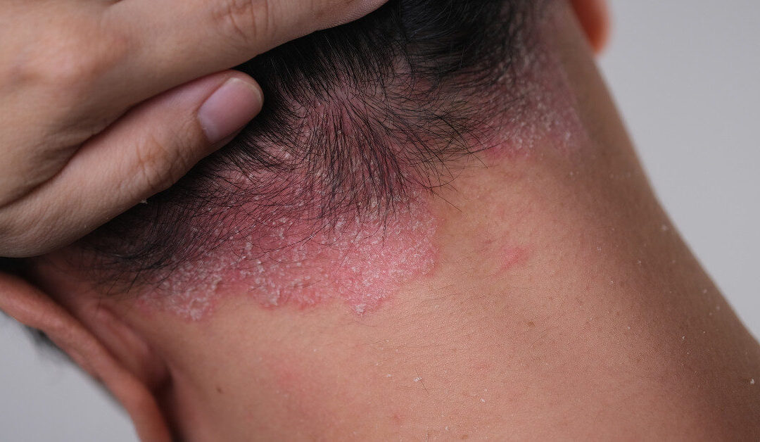 Find Relief from Psoriasis This Winter